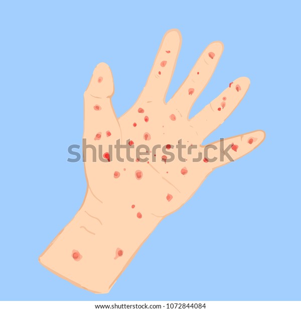 Illustration Hands Inflamed Blisters Hfmd Stock Vector (Royalty Free ...