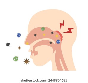 Illustration of the head seen from the side, where the nasopharynx becomes inflamed with bacteria