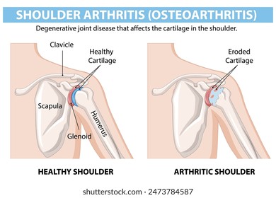 Illustration of healthy and arthritic shoulder joints