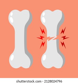 illustration of healthy bones and fractured bones.