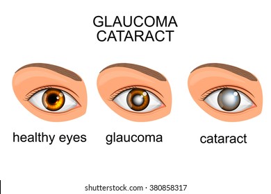 Illustration Of A Healthy Eye, Glaucoma, Cataract