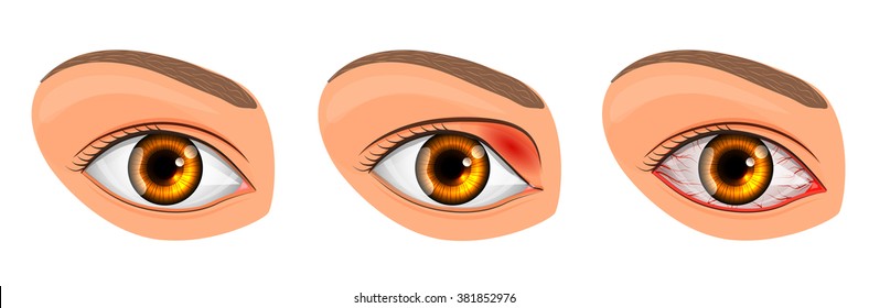 illustration of a healthy eye, the patient with conjunctivitis and styes