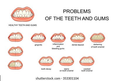 illustration of healthy gums and teeth and oral cavity diseases