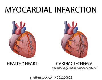 Illustration Healthy Human Heart Heart Attacks Stock Vector (Royalty ...