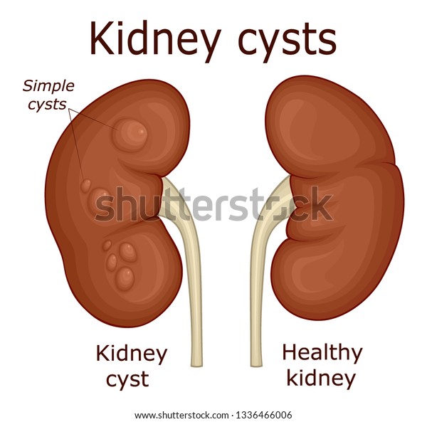 Illustration Healthy Kidney Simple Kidney Cysts Stock Vector (Royalty ...