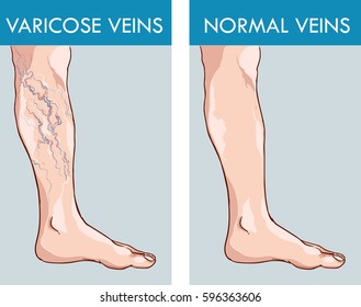Vein Chart For Shooting Up