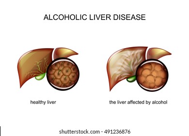 Normal Liver Versus Liver Cirrhosis Damaged Stock Illustration ...