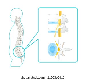 Illustration Of A Healthy Lumbar Spine Vertebrae And Sciatic Nerve