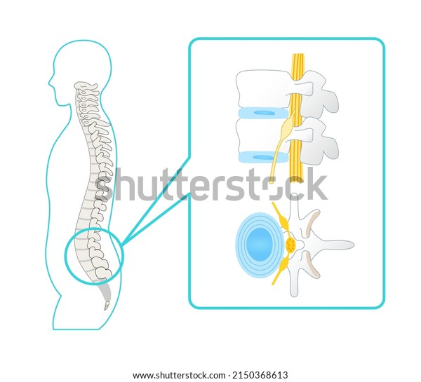 Illustration of a healthy lumbar spine Vertebrae\
and sciatic nerve