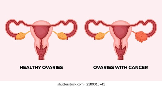 illustration healthy ovaries, and ovaries with cancer