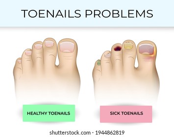 Illustration of healthy and sick toenails