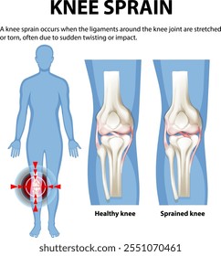 Ilustração da anatomia saudável e torcida do joelho