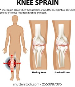 Illustration of healthy and sprained knee anatomy