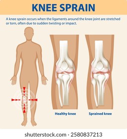 Illustration of healthy and sprained knee anatomy