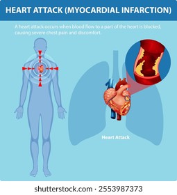 Illustration of heart attack causes and symptoms