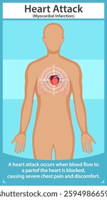 Illustration of heart attack and its effects