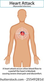 Illustration of heart attack and its symptoms