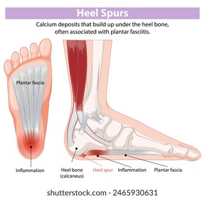 Illustration of heel spurs and inflammation