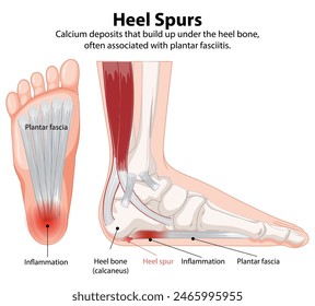 Illustration of heel spurs and plantar fasciitis