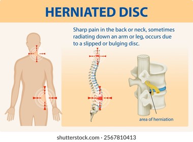 Illustration of herniated disc and associated pain areas