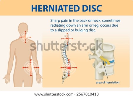 Illustration of herniated disc and associated pain areas