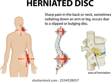 Illustration of herniated disc and pain areas