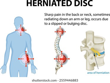 Illustration of herniated disc and pain areas