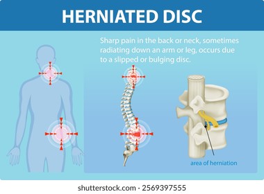 Illustration of herniated disc and pain areas