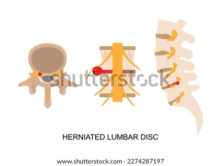 Illustration of herniated lumbar disc in different view.