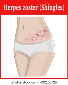 Illustration Of Herpes Zoster