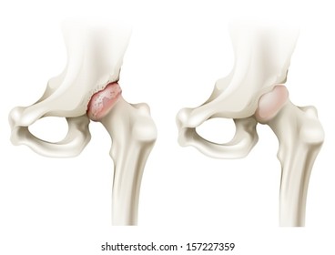 Illustration Of The Hip Arthritis On A White Background