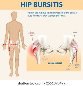 Ilustración de la bursitis de cadera y las áreas afectadas