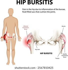 Illustration of hip bursitis and joint inflammation