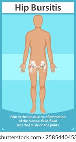 Illustration of hip bursitis and joint inflammation