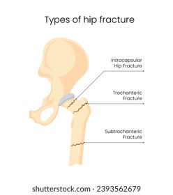 Ilustración de la fractura de cadera