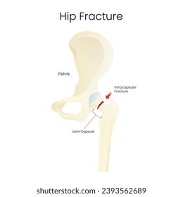 Ilustración de la fractura de cadera