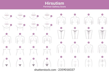 Illustration of hirsutism concept facial hair body hair in women