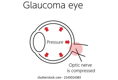 Ilustración del funcionamiento del glaucoma, glaucoma ocular, ilustración médica