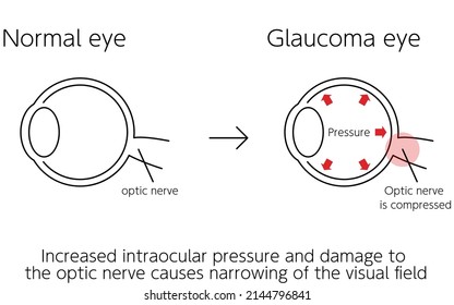 Illustration wie Glaukoma wirkt, normale und glaukomatöse Augen, medizinische Illustration