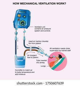 Illustration of how mechanical ventilator on corona virus patient work, respiratory device treatment
