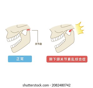 Illustration of how temporomandibular disorders work　Translation; Mechanism of temporomandibular disorders Joint disc
