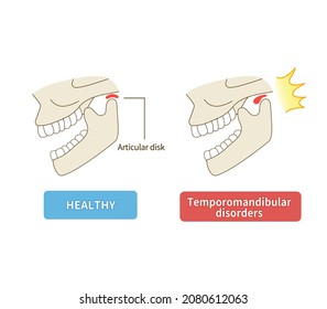 Illustration of how temporomandibular disorders work