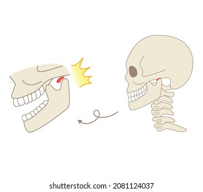 Illustration of how temporomandibular disorders work