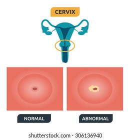 Illustration of human cervical structure; normal vs. cancer