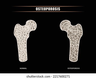 Ilustración de un fémur humano frente a la comparación intraarticular de cadera de síntomas óseos normales con osteoporosis. Para uso médico, educativo y comercial.