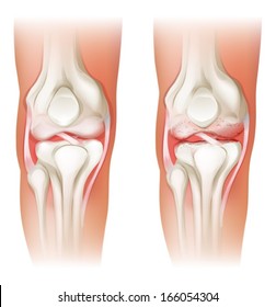 Illustration of the human knee arthritis on a white background