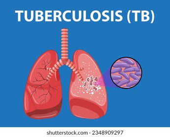 Illustration of human lung anatomy showcasing tuberculosis infection