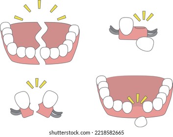 Illustration Of An Image With Broken Dentures