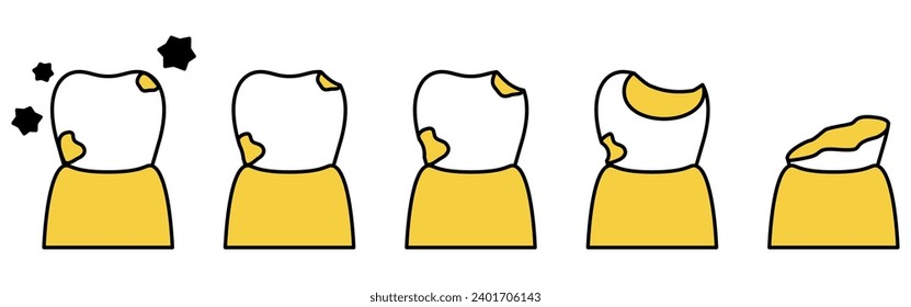 Illustration of image of cavity progression, simple line drawing, Vector Illustration