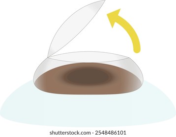 Illustration of image of corneal flap opening in corrective vision surgery